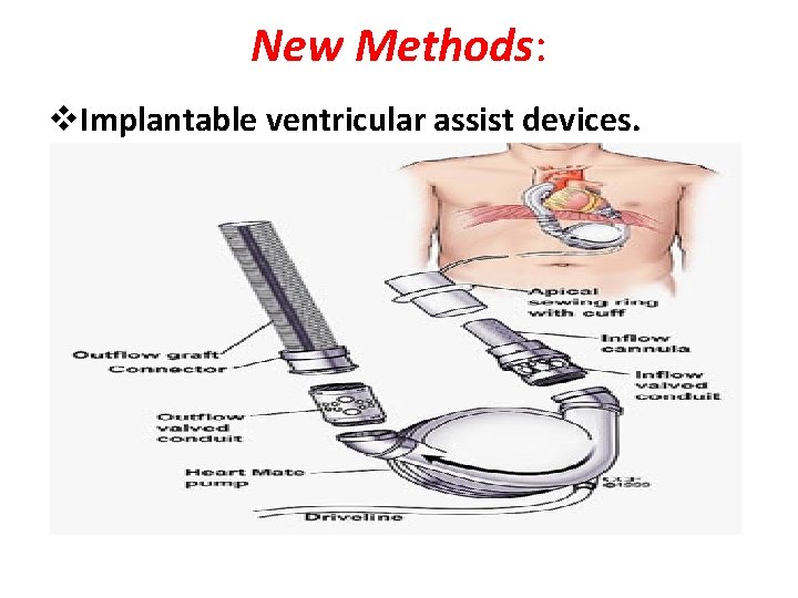 New Methods: v. Implantable ventricular assist devices. 