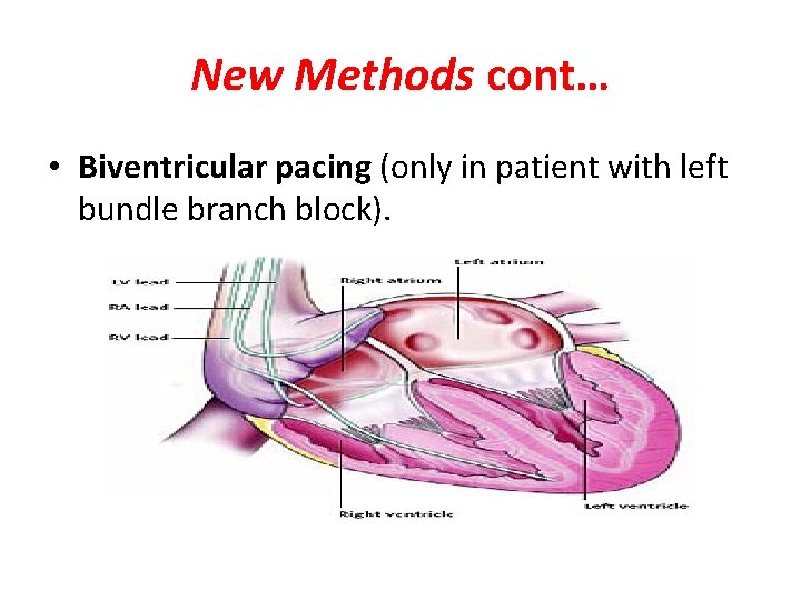 New Methods cont… • Biventricular pacing (only in patient with left bundle branch block).
