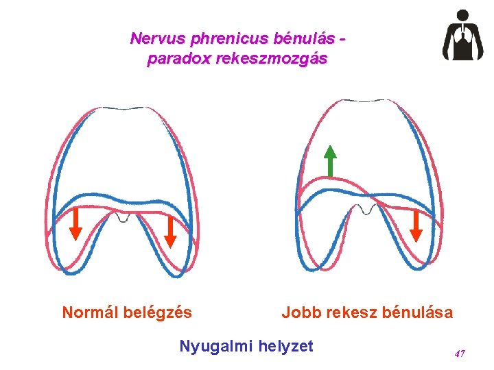 Nervus phrenicus bénulás paradox rekeszmozgás Normál belégzés Jobb rekesz bénulása Nyugalmi helyzet 47 