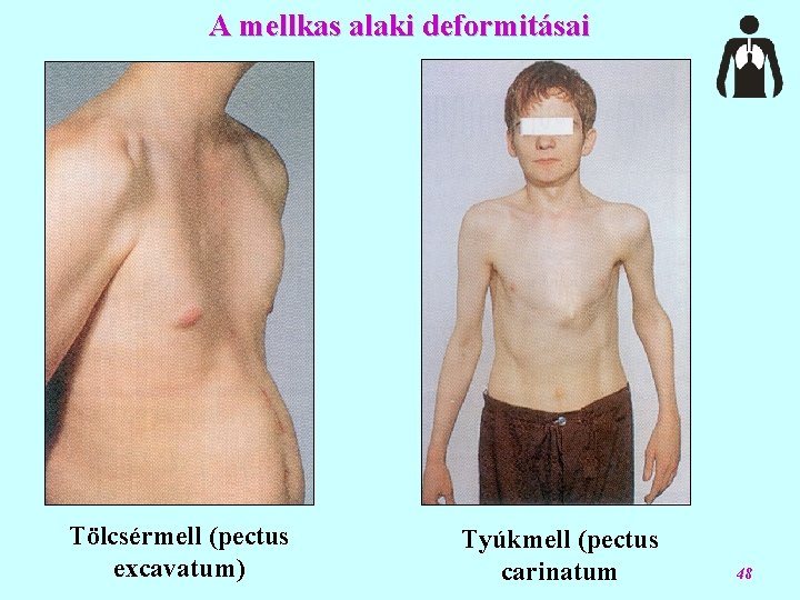 A mellkas alaki deformitásai Tölcsérmell (pectus excavatum) Tyúkmell (pectus carinatum 48 