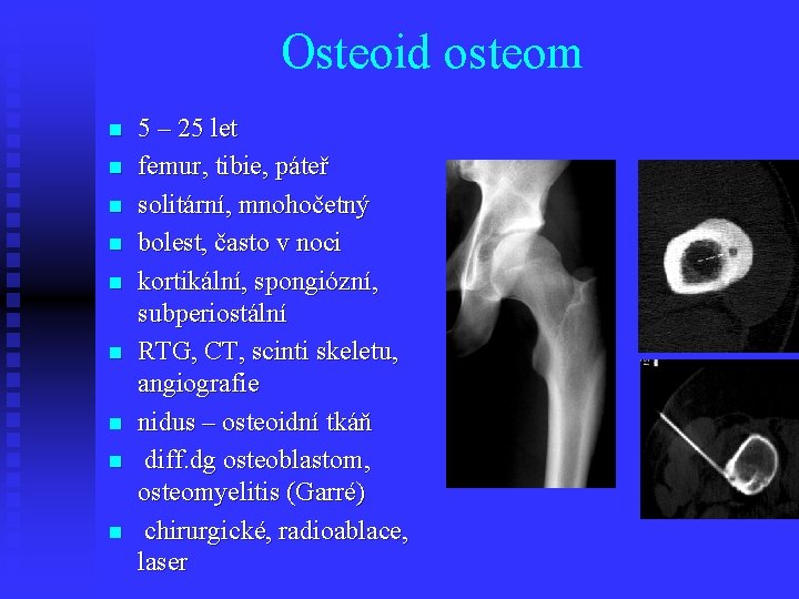 Osteoid osteom n n n n n 5 – 25 let femur, tibie, páteř