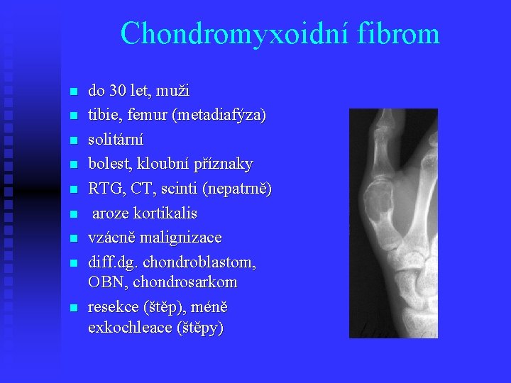 Chondromyxoidní fibrom n n n n n do 30 let, muži tibie, femur (metadiafýza)
