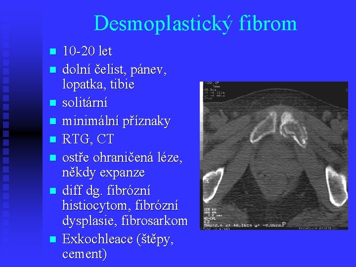 Desmoplastický fibrom n n n n 10 -20 let dolní čelist, pánev, lopatka, tibie