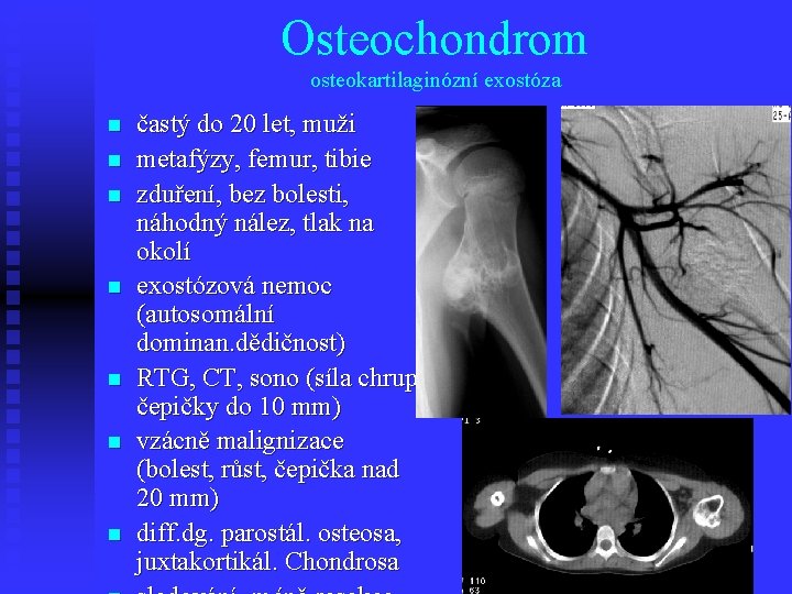 Osteochondrom osteokartilaginózní exostóza n n n n častý do 20 let, muži metafýzy, femur,