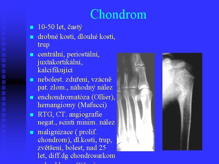 Chondrom n n n n 10 -50 let, častý drobné kosti, dlouhé kosti, trup