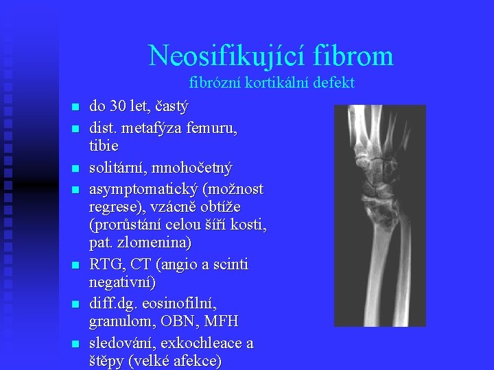 Neosifikující fibrom n n n n fibrózní kortikální defekt do 30 let, častý dist.