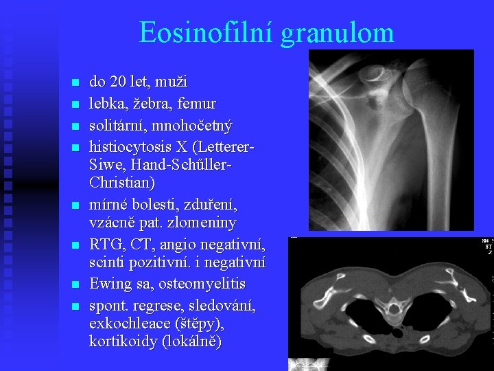 Eosinofilní granulom n n n n do 20 let, muži lebka, žebra, femur solitární,