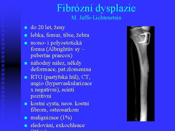 Fibrózní dysplazie M. Jaffe-Lichtenstein n n n n do 20 let, ženy lebka, femur,