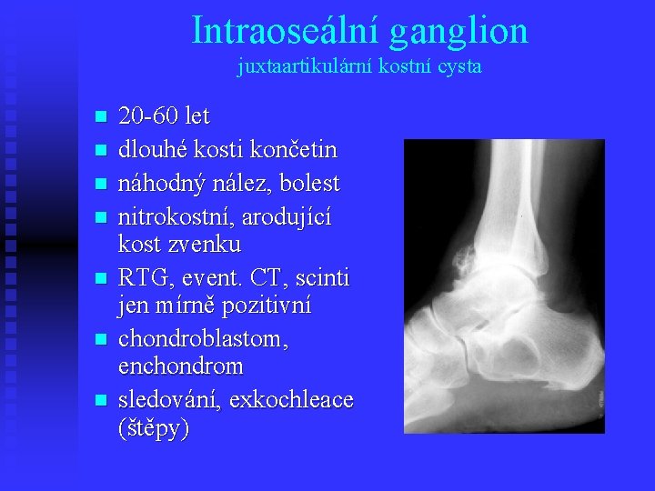 Intraoseální ganglion juxtaartikulární kostní cysta n n n n 20 -60 let dlouhé kosti