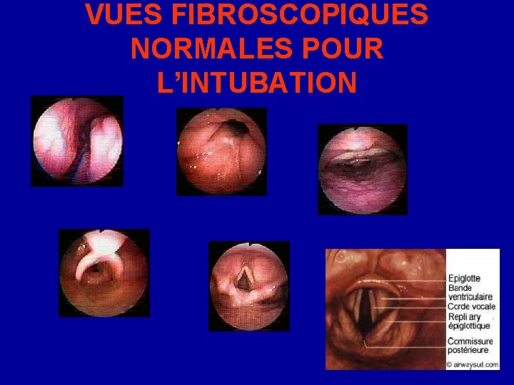 VUES FIBROSCOPIQUES NORMALES POUR L’INTUBATION 