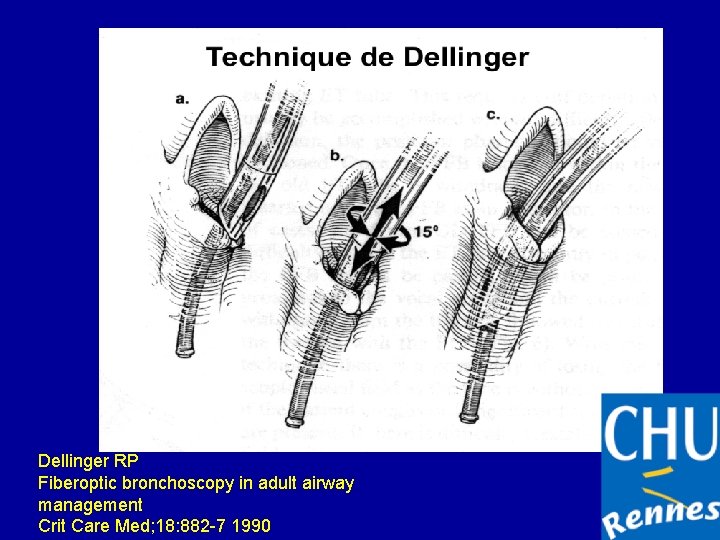 Dellinger RP Fiberoptic bronchoscopy in adult airway management Crit Care Med; 18: 882 -7