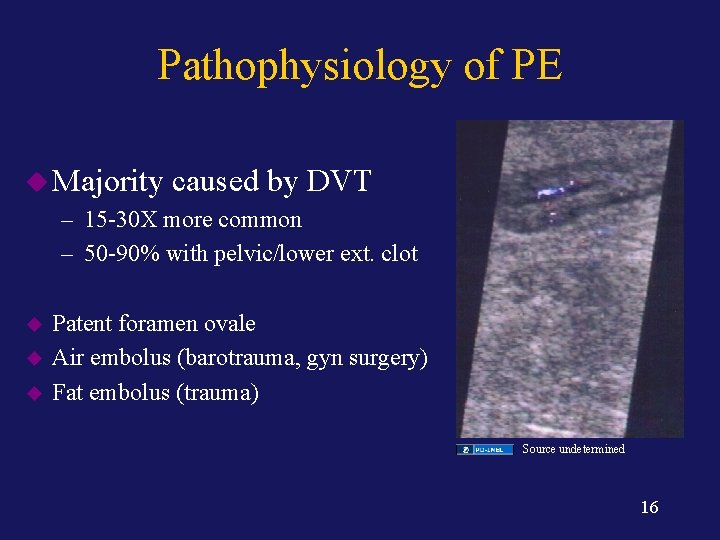 Pathophysiology of PE u Majority caused by DVT – 15 -30 X more common