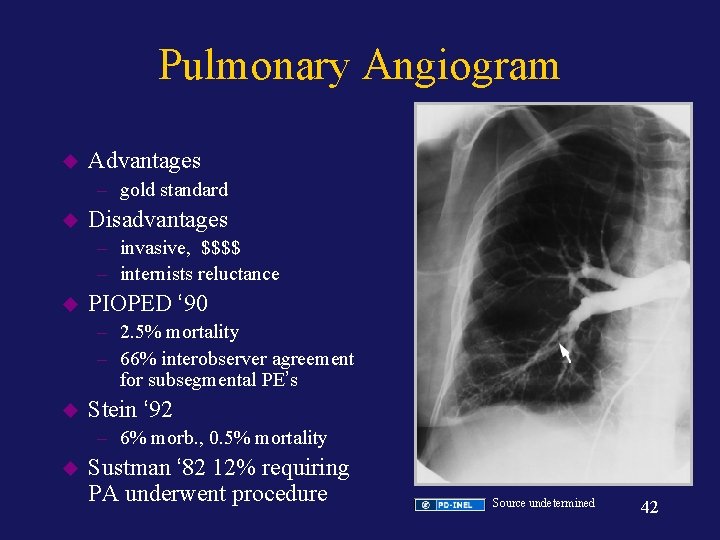 Pulmonary Angiogram u Advantages – gold standard u Disadvantages – invasive, $$$$ – internists