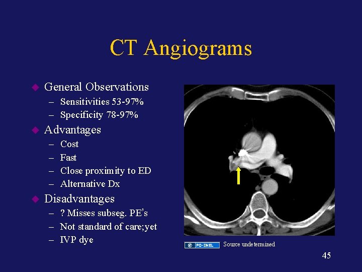 CT Angiograms u General Observations – Sensitivities 53 -97% – Specificity 78 -97% u