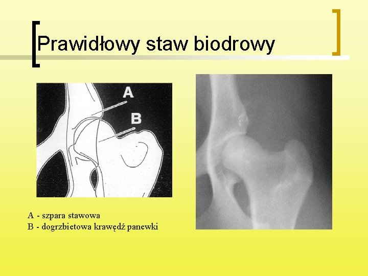 Prawidłowy staw biodrowy A - szpara stawowa B - dogrzbietowa krawędź panewki 