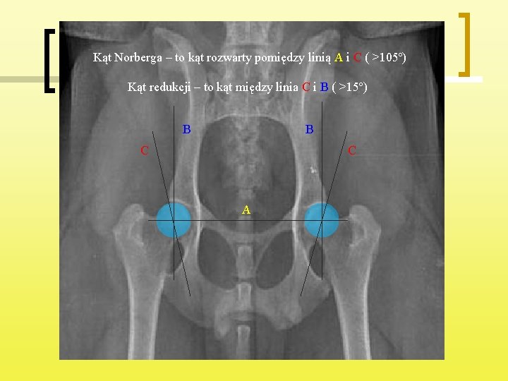 Kąt Norberga – to kąt rozwarty pomiędzy linią A i C ( >105º) Kąt