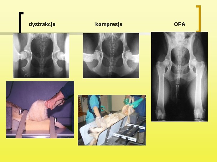 dystrakcja kompresja OFA 