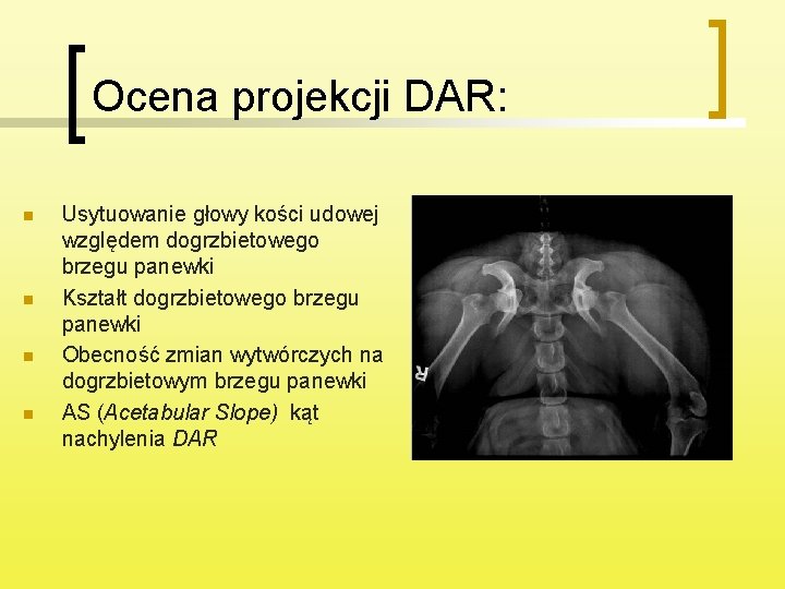 Ocena projekcji DAR: n n Usytuowanie głowy kości udowej względem dogrzbietowego brzegu panewki Kształt