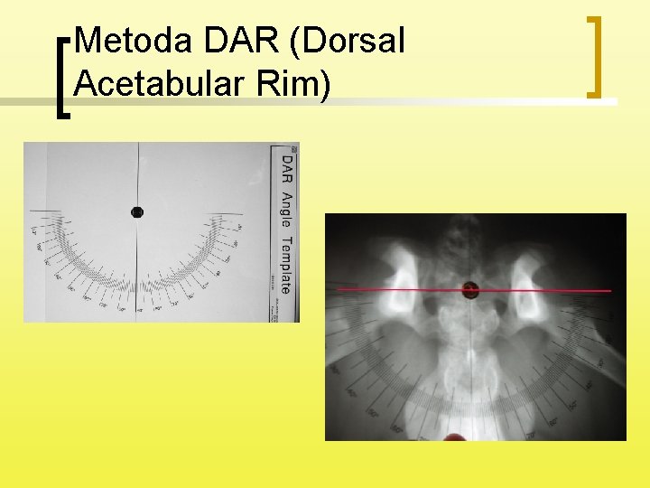 Metoda DAR (Dorsal Acetabular Rim) 