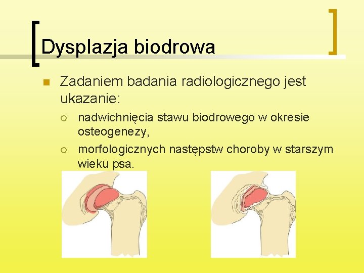 Dysplazja biodrowa n Zadaniem badania radiologicznego jest ukazanie: ¡ ¡ nadwichnięcia stawu biodrowego w