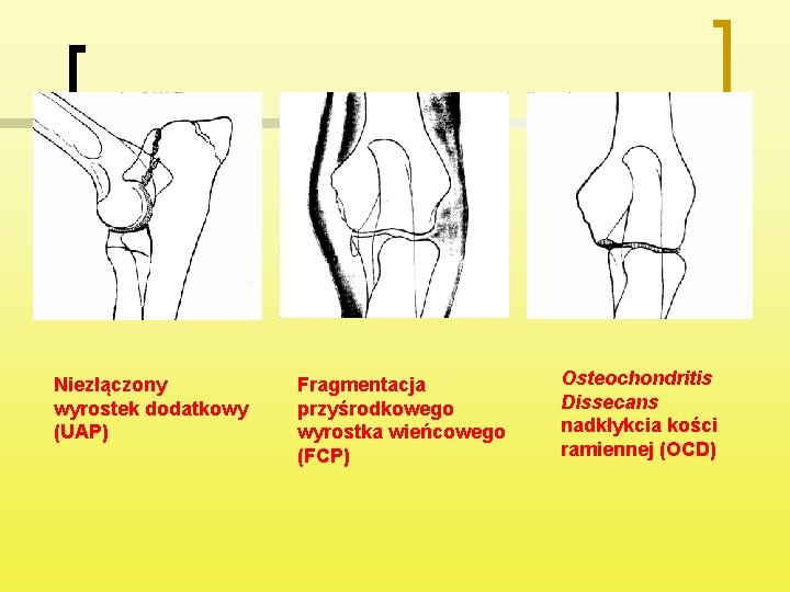 Niezłączony wyrostek dodatkowy (UAP) Fragmentacja przyśrodkowego wyrostka wieńcowego (FCP) Osteochondritis Dissecans nadkłykcia kości ramiennej