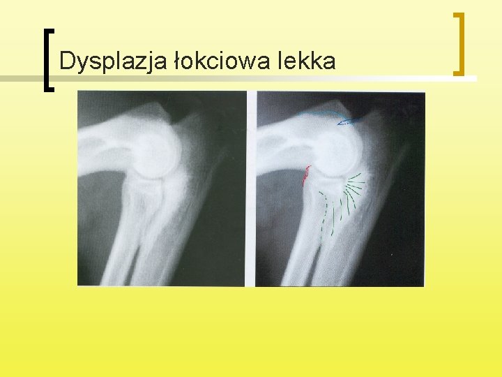 Dysplazja łokciowa lekka 