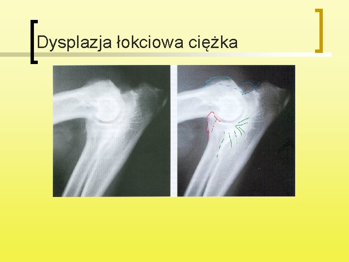 Dysplazja łokciowa ciężka 