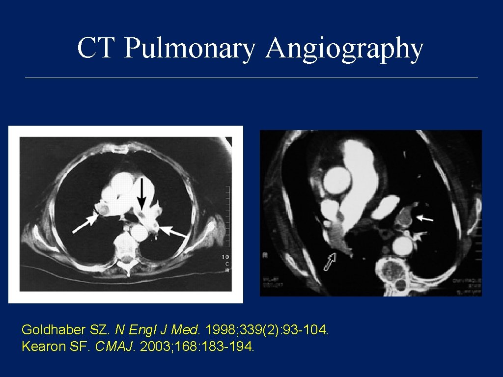 CT Pulmonary Angiography Goldhaber SZ. N Engl J Med. 1998; 339(2): 93 -104. Kearon