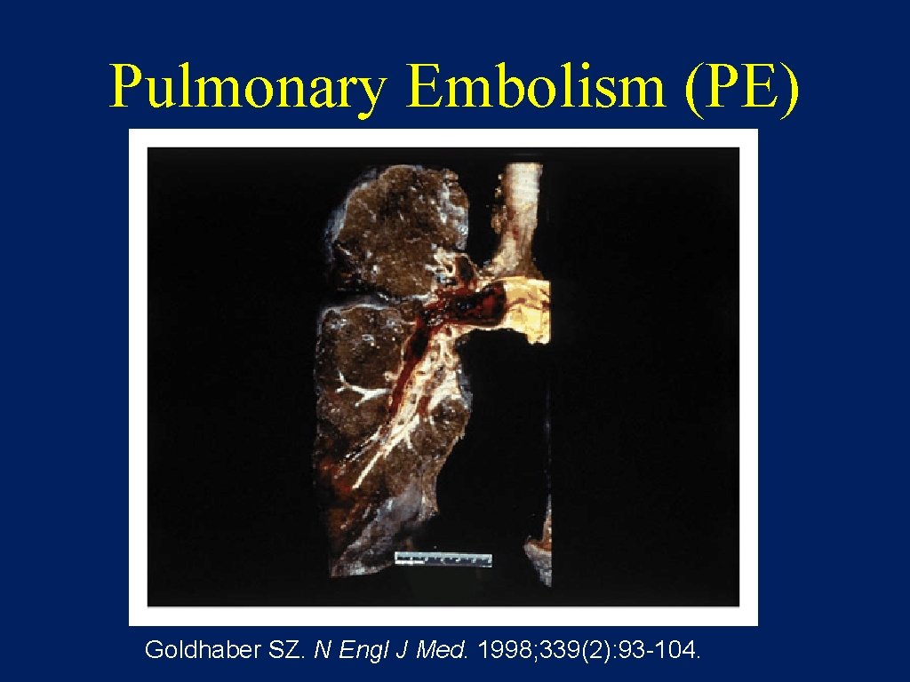 Pulmonary Embolism (PE) Goldhaber SZ. N Engl J Med. 1998; 339(2): 93 -104. 