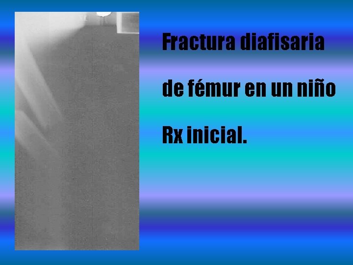 Fractura diafisaria de fémur en un niño Rx inicial. 