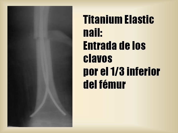 Titanium Elastic nail: Entrada de los clavos por el 1/3 inferior del fémur 