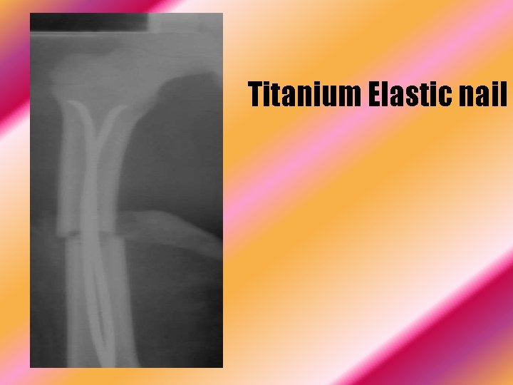 Titanium Elastic nail 