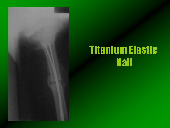 Titanium Elastic Nail 