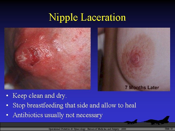 Nipple Laceration • Keep clean and dry. • Stop breastfeeding that side and allow
