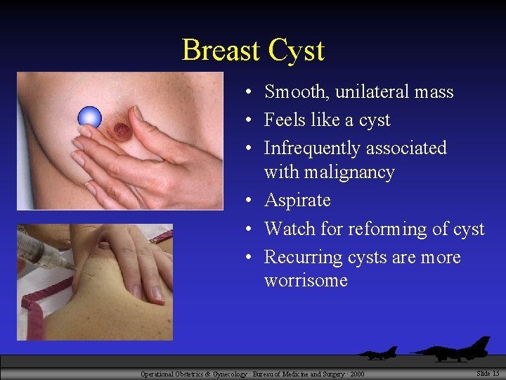 Breast Cyst • Smooth, unilateral mass • Feels like a cyst • Infrequently associated