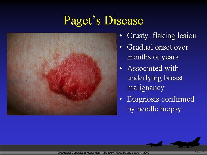 Paget’s Disease • Crusty, flaking lesion • Gradual onset over months or years •