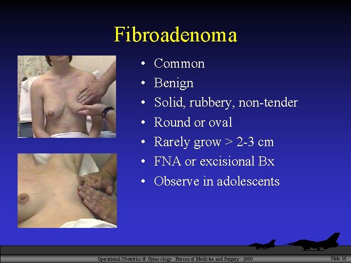 Fibroadenoma • • Common Benign Solid, rubbery, non-tender Round or oval Rarely grow >
