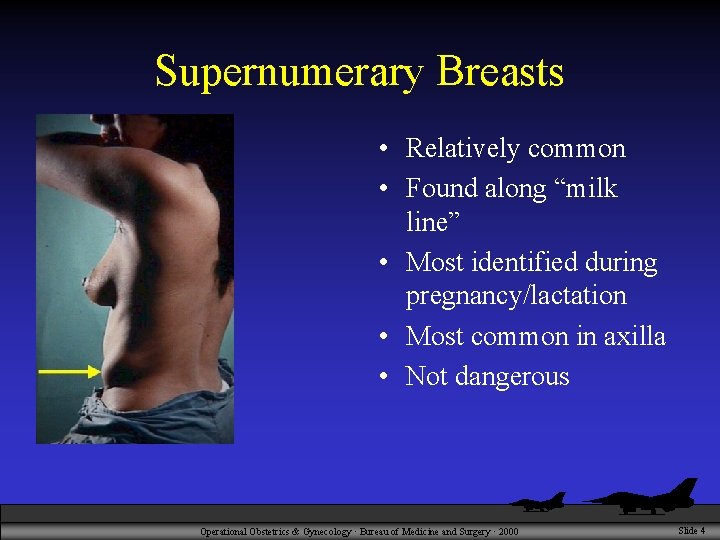 Supernumerary Breasts • Relatively common • Found along “milk line” • Most identified during