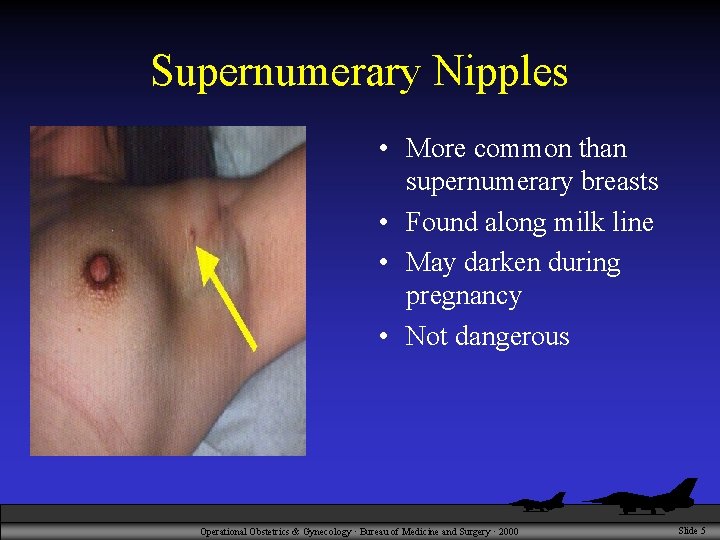 Supernumerary Nipples • More common than supernumerary breasts • Found along milk line •