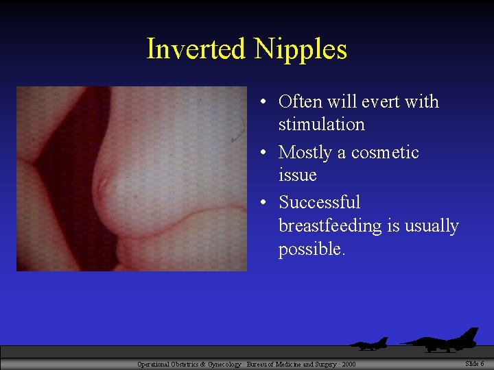 Inverted Nipples • Often will evert with stimulation • Mostly a cosmetic issue •
