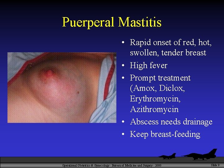 Puerperal Mastitis • Rapid onset of red, hot, swollen, tender breast • High fever