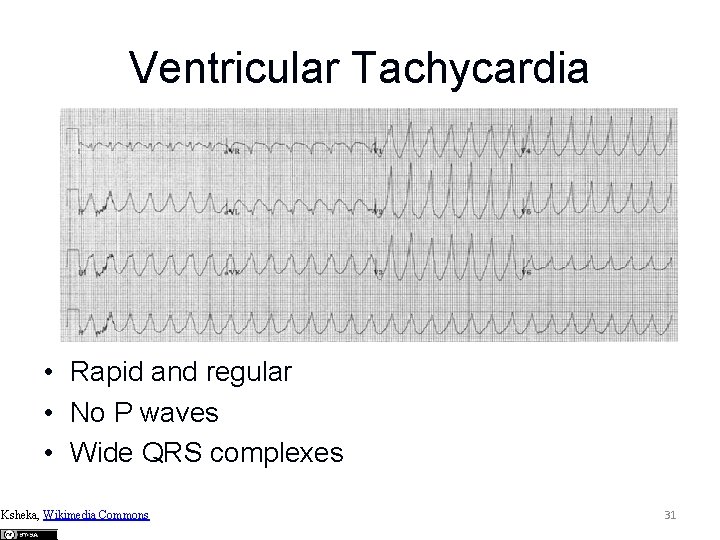 Ventricular Tachycardia • Rapid and regular • No P waves • Wide QRS complexes