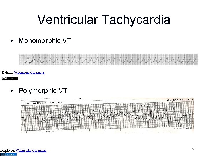 Ventricular Tachycardia • Monomorphic VT Ksheka, Wikimedia Commons • Polymorphic VT Displaced, Wikimedia Commons