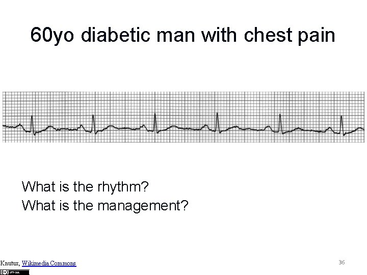 60 yo diabetic man with chest pain What is the rhythm? What is the