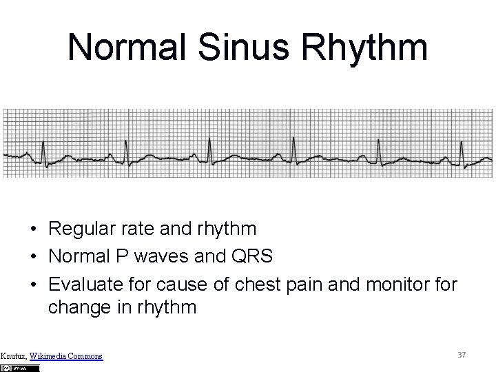 Normal Sinus Rhythm • Regular rate and rhythm • Normal P waves and QRS