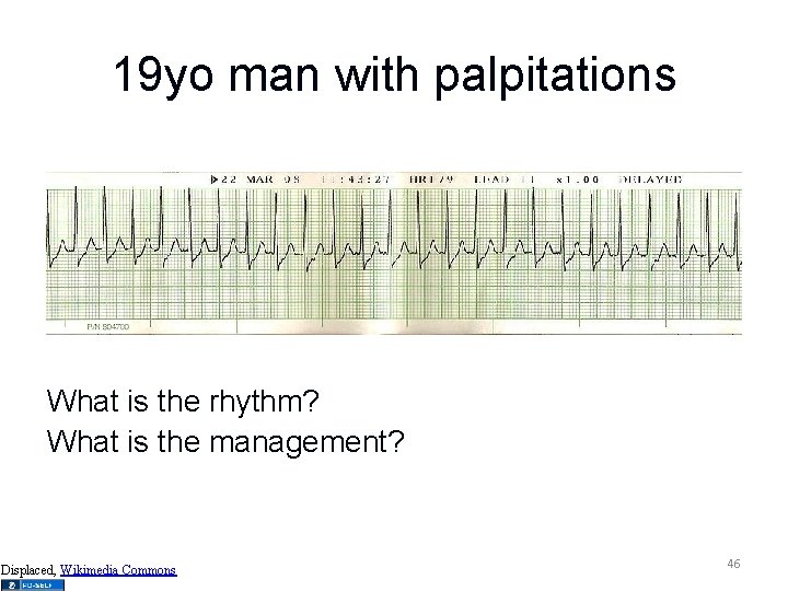 19 yo man with palpitations What is the rhythm? What is the management? Displaced,