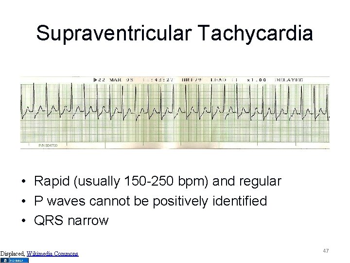 Supraventricular Tachycardia • Rapid (usually 150 -250 bpm) and regular • P waves cannot