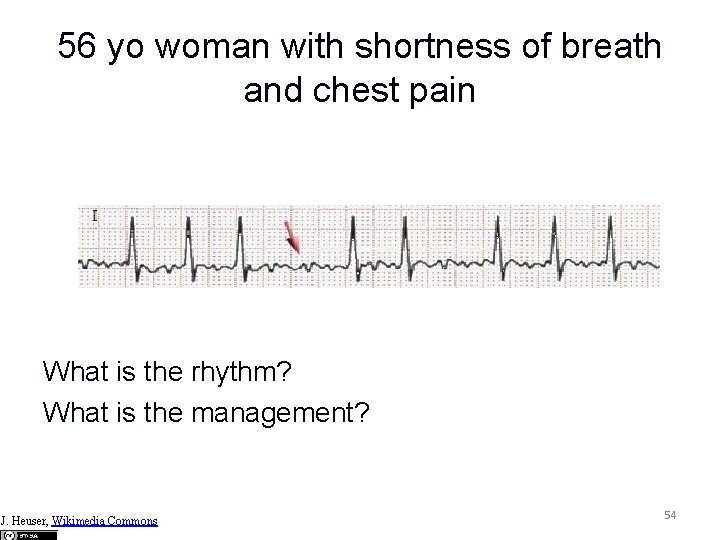 56 yo woman with shortness of breath and chest pain What is the rhythm?