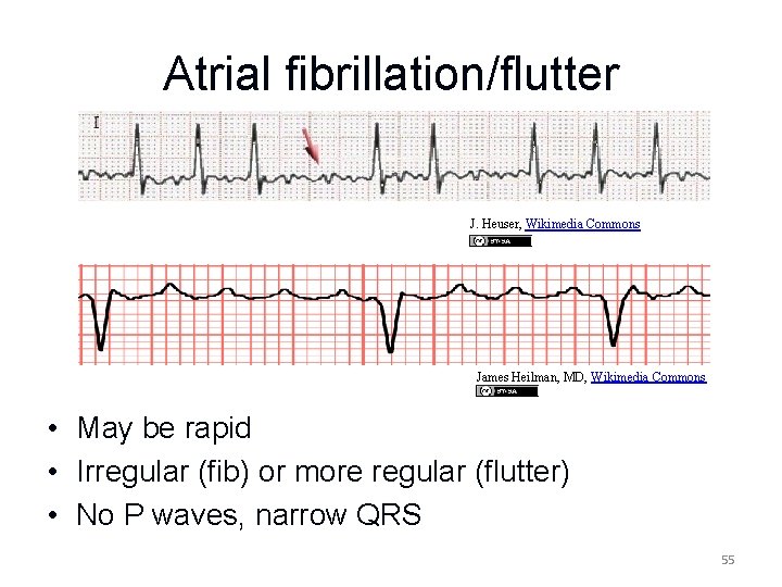 Atrial fibrillation/flutter J. Heuser, Wikimedia Commons James Heilman, MD, Wikimedia Commons • May be