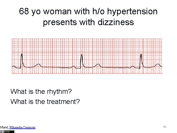 68 yo woman with h/o hypertension presents with dizziness What is the rhythm? What